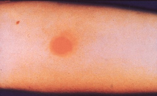 Pictures Of Negative And Positive Ppd Test 101